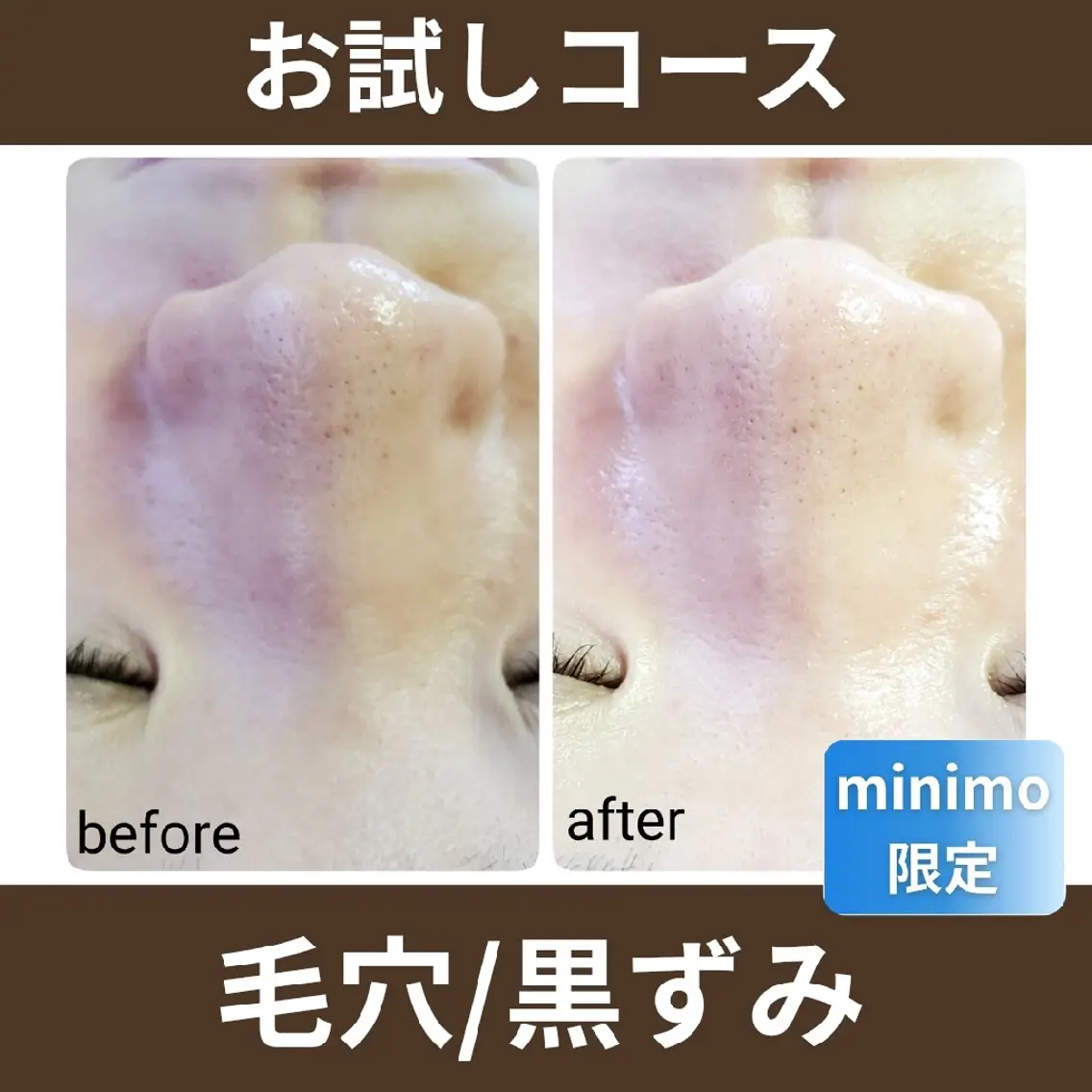 【お試し】ハーブピーリングの写真