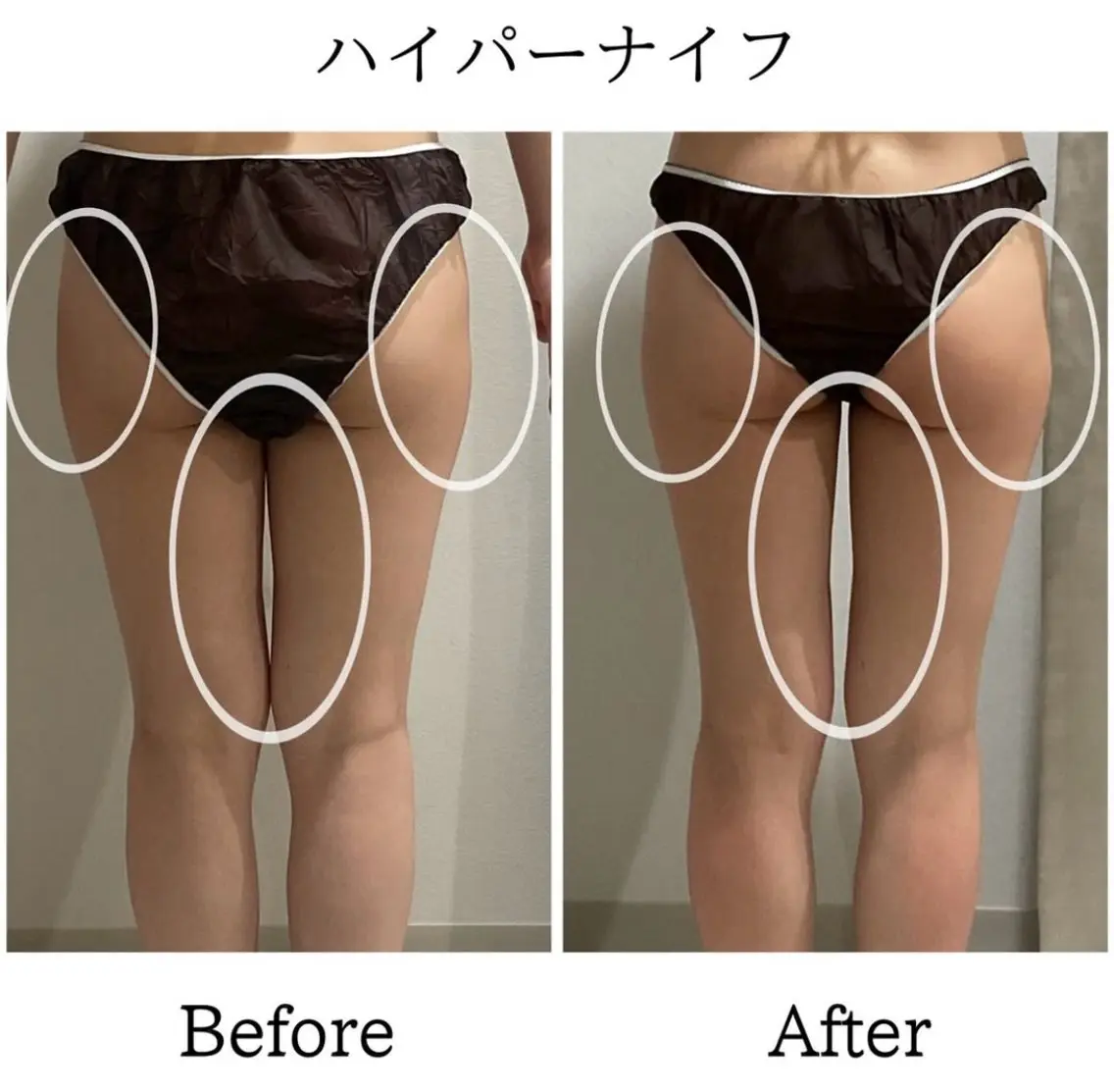 下半身痩せ🔥パンツ・スカートが映える脚に👗短時間でスッキリ!¥25,300→¥6,600の写真
