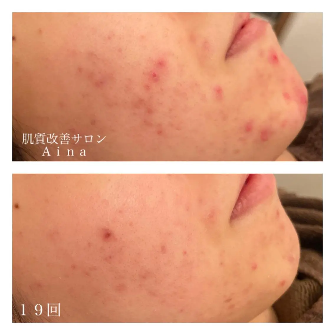 セミロング カラー パーマ ヘアアレンジ メンズ キッズ ネイル マツエク・マツパ 赤色 エステ リラク ニキビ跡専門サロン Ainaのエステ・リラクイメージ