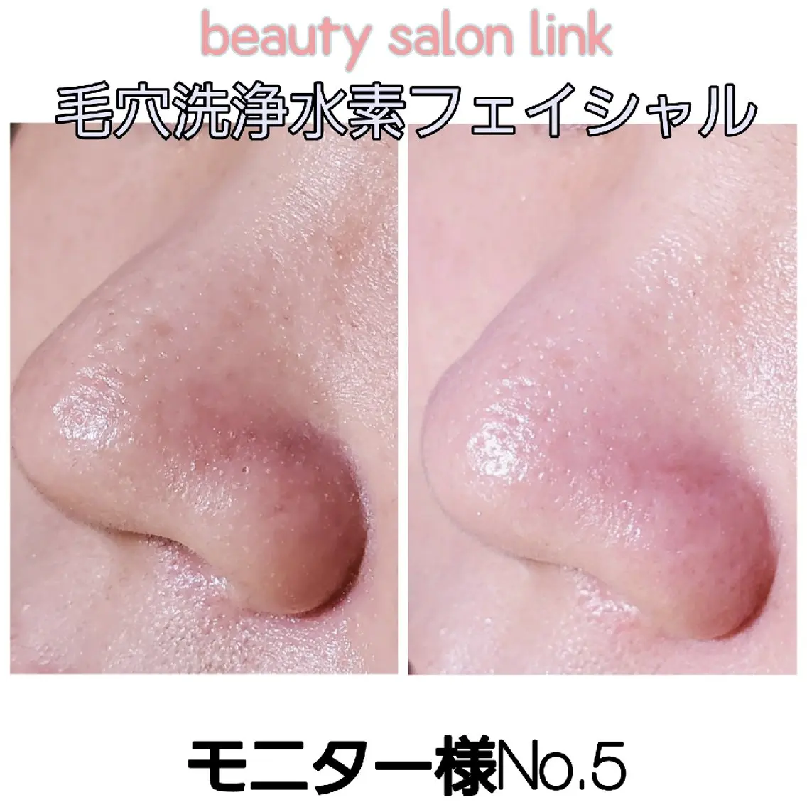 🫧期間限定🫧ミニモ限定メニュー🙆毛穴の大掃除！水素毛穴洗浄フェイシャル✨韓国生パック付きでプルプル♪50分の写真