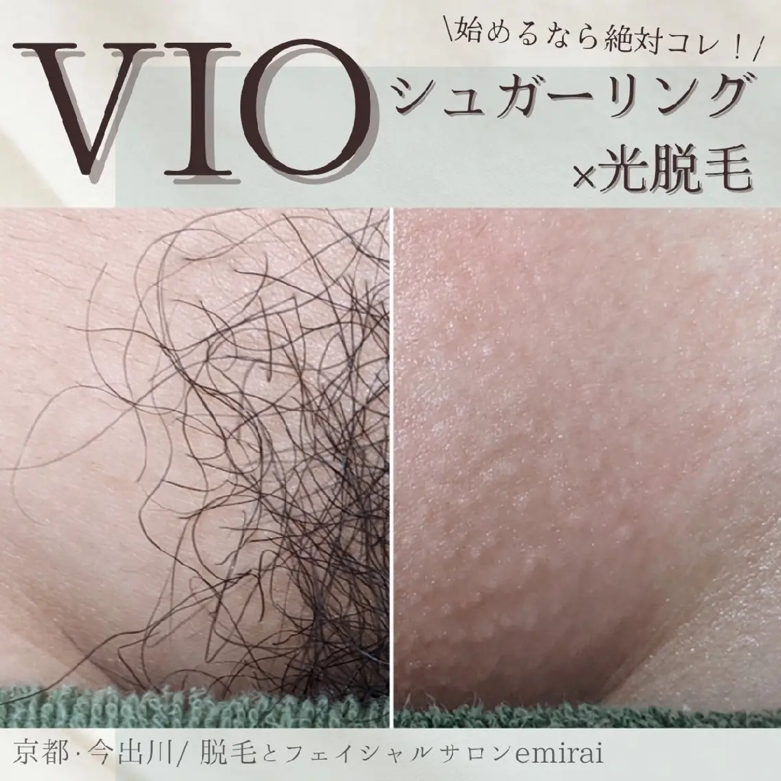 『人気Ｎｏ．1脱毛』シュガーリング🍯+最新式光脱毛✨で当日からつるつる！チクチクしないVIOmix脱毛🍯💕の写真