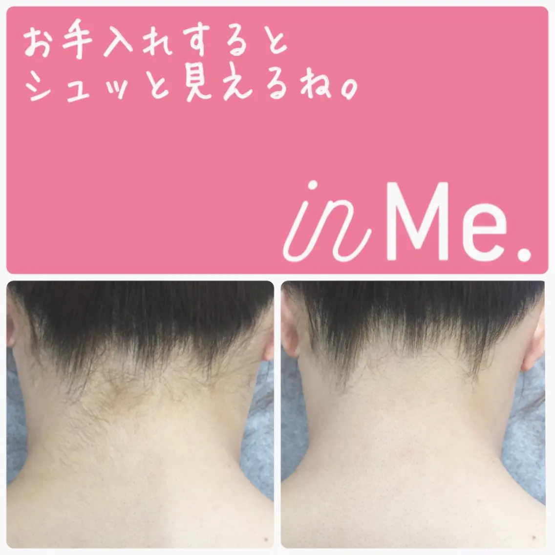 🌸お顔とうなじの脱毛🌸綺麗なうなじとうぶ毛のないお顔でメイクのノリもよく艶肌にの写真
