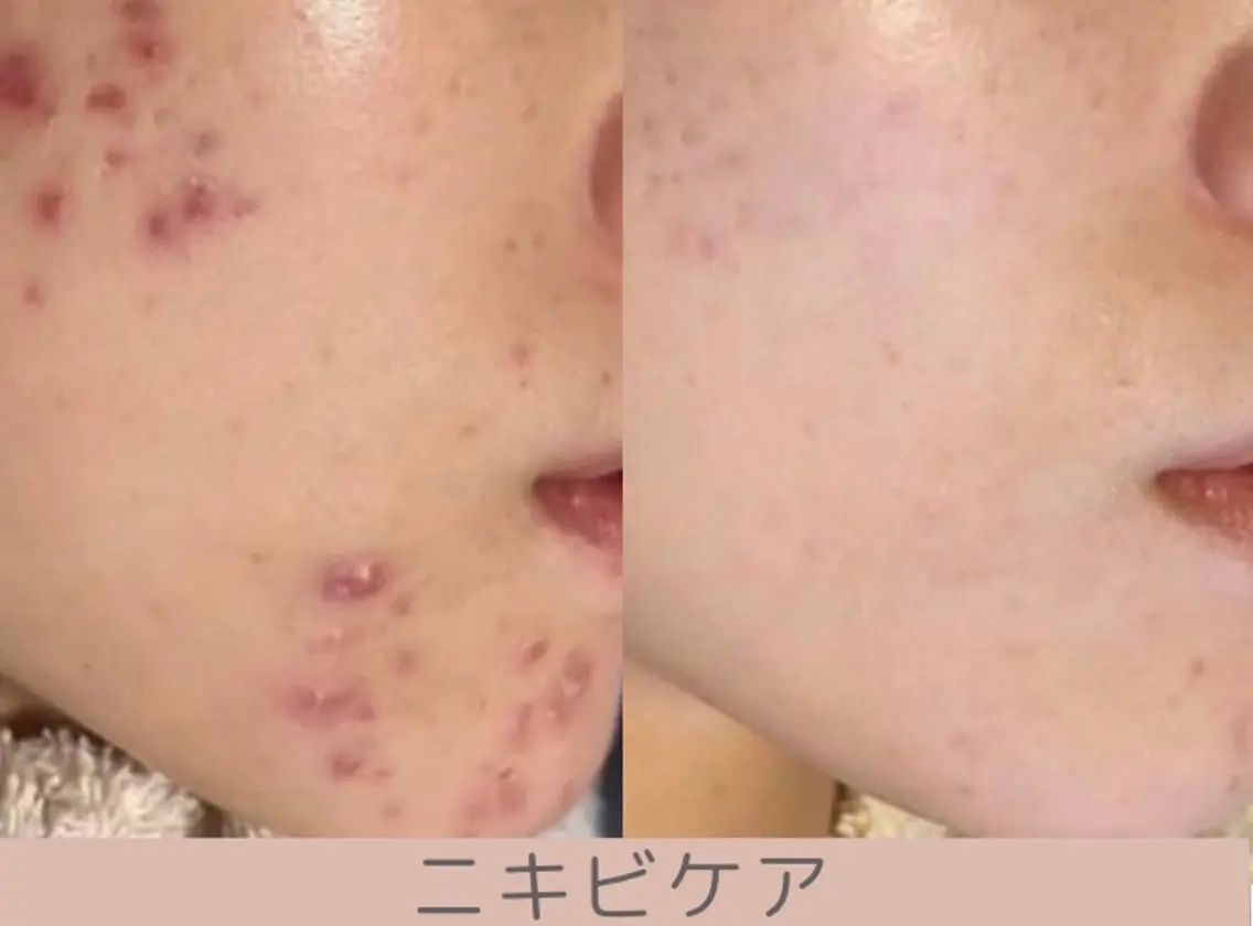 小顔/毛穴/ニキビ salon bealのエステ・リラクイメージ