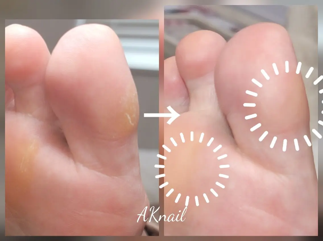 その他(ネイル) ネイル&巻き爪サロン 　AKnailのネイルデザイン