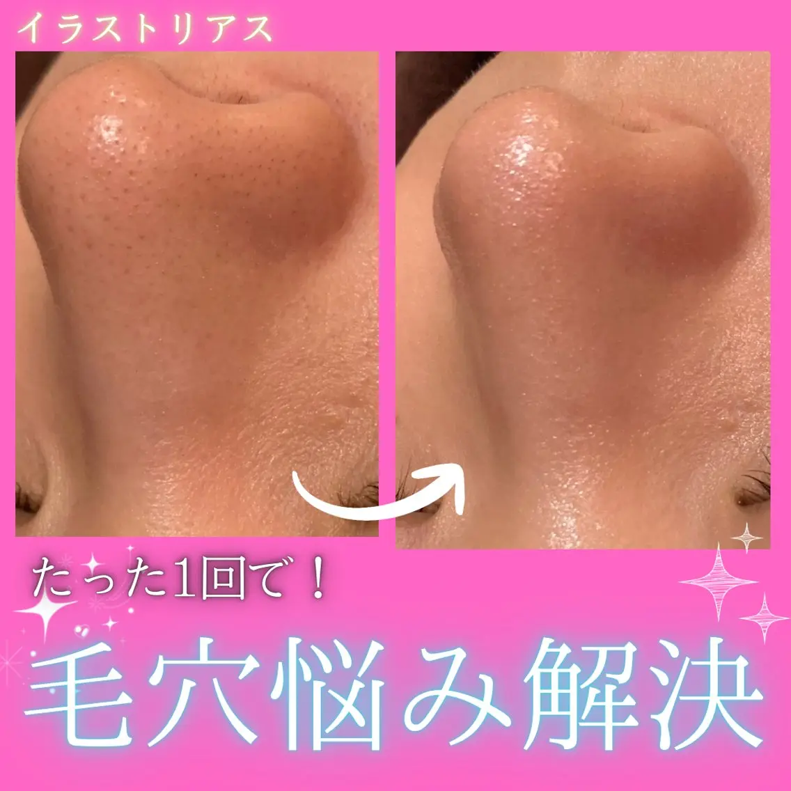 【毛穴スッキリケア🫧】毛穴の汚れを水流で優しく吸引⚡️透明感をだしてみずみずしい卵肌へと導く💎の写真