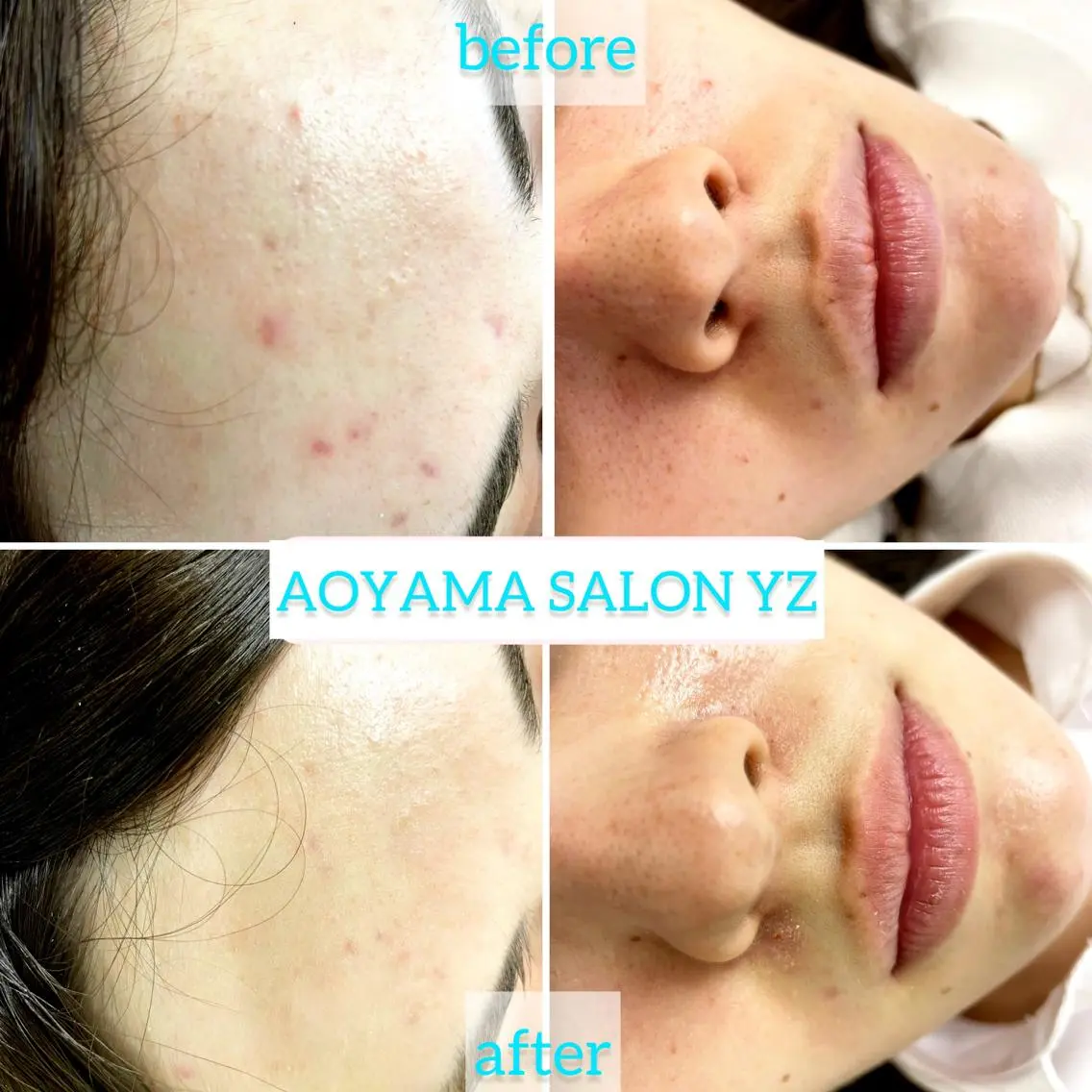 【ニキビお悩み専用】ビタミンC導入×ハイパワー毛穴洗浄×美容鍼の写真