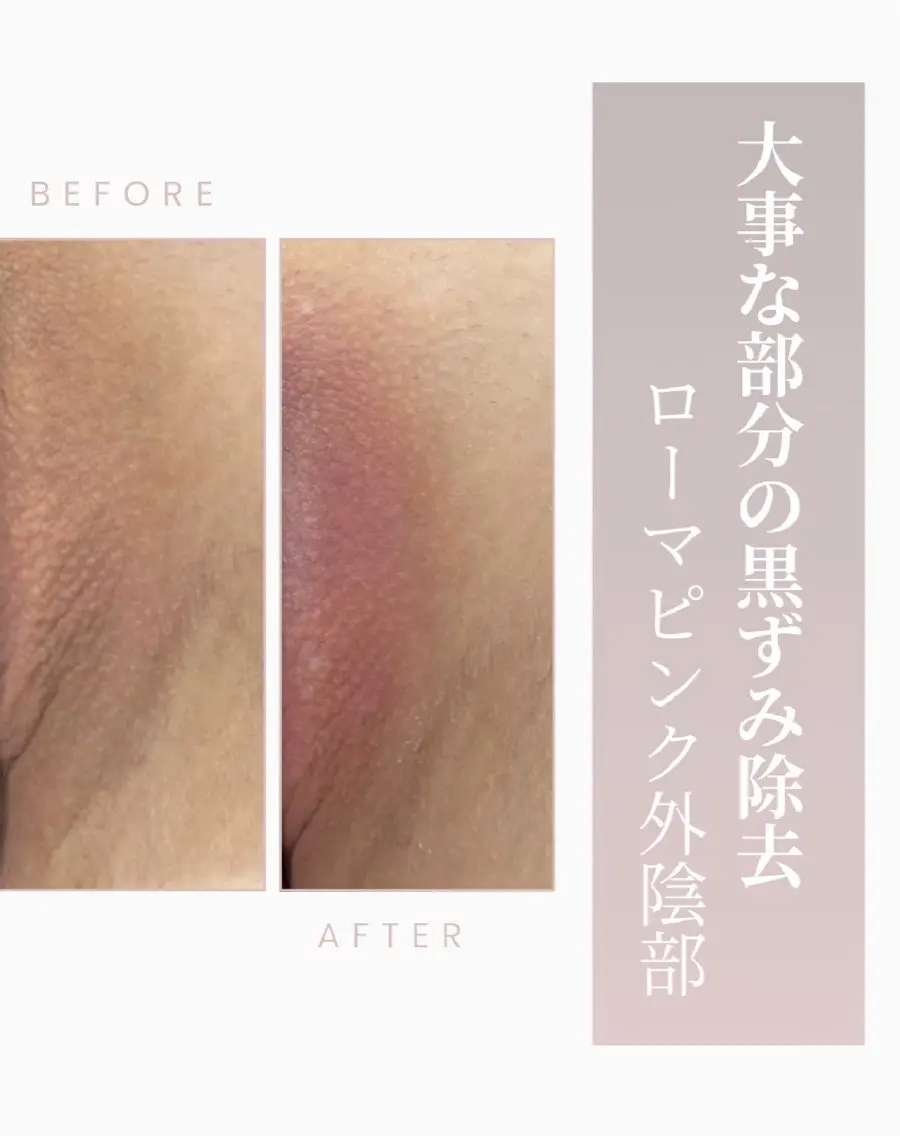 【世界中で話題ローマピンク】陰部の黒ずみから本来のピンクへの写真