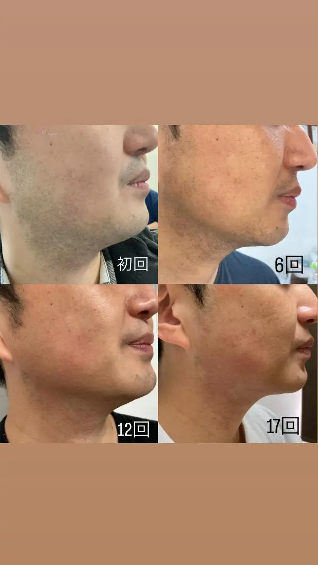 メンズヒゲ脱毛の写真