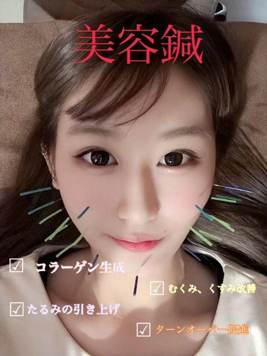 🌈美容鍼(美顔針)＋ローラ鍼＋肩甲骨剥がし🌈ミニモ学割の写真