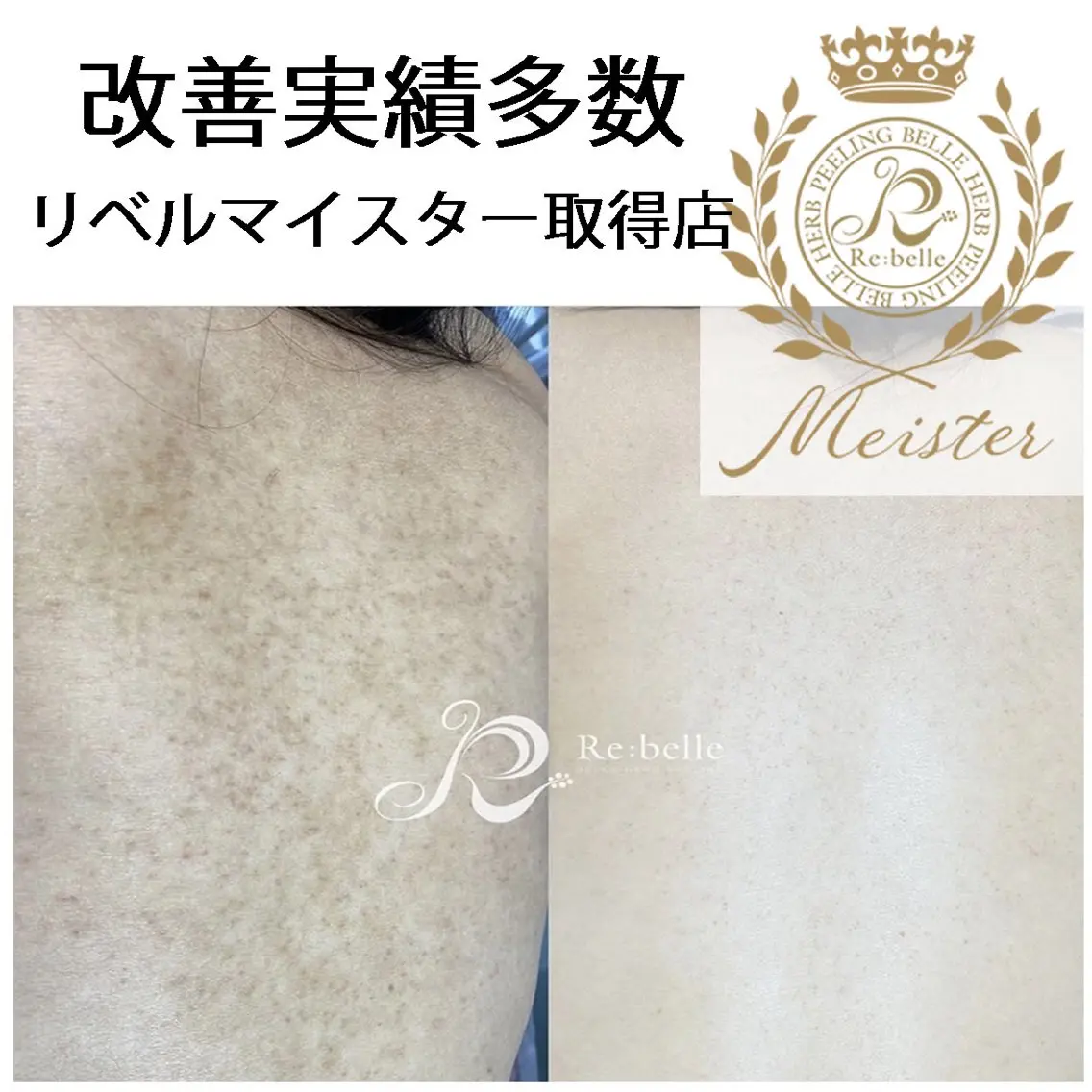 【剥離あり/ニキビケア毛孔性】リベルハーブピーリング背中上（2000円券付）90分の写真