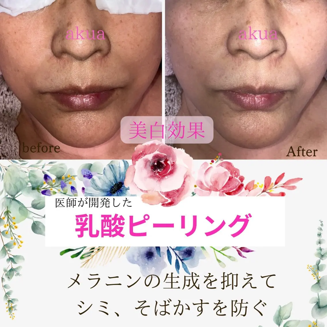 【ツヤ美肌ケア】乳酸ピーリングで美白、ツルモチ肌!!★小顔ハンドフェイシャル&幹細胞パック!ミニモ限定の写真