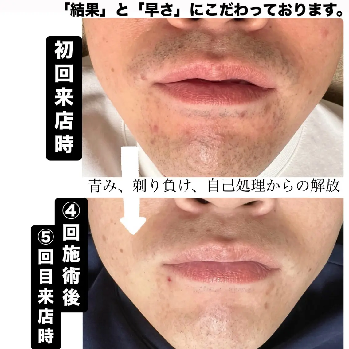 メンズ 脱毛 メンズ脱毛サロン Le falcoのエステ・リラクイメージ