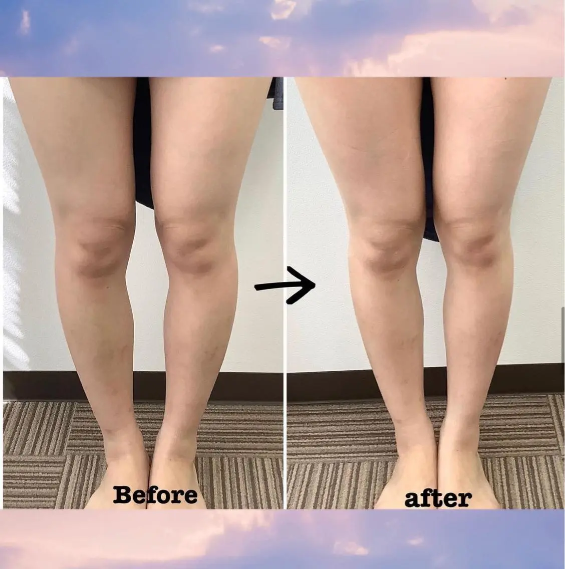 脚集中コース🌟 筋膜の癒着改善◎ 浮腫とり👠【筋膜リリース】の写真
