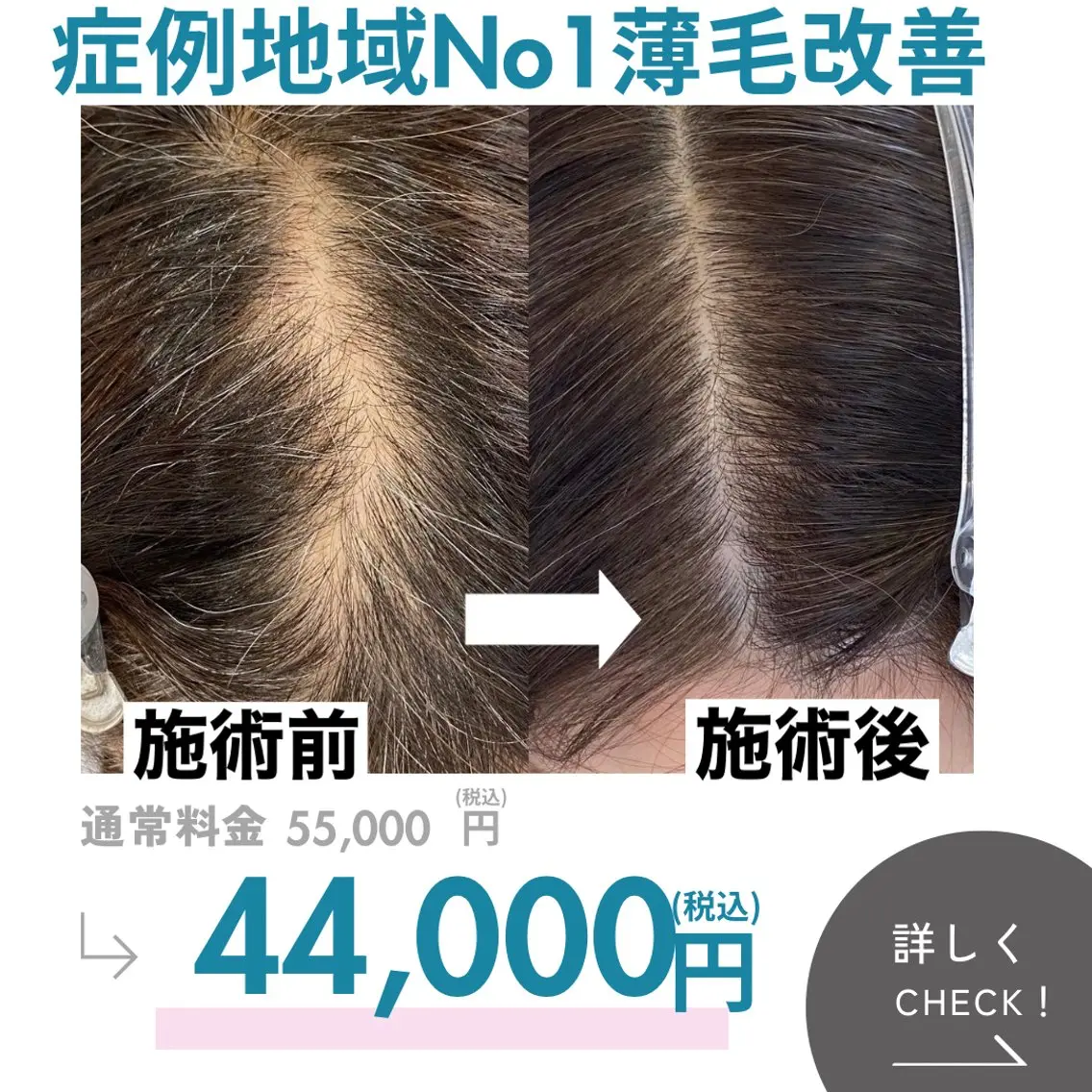 本気の薄毛改善 もう隠さない 頭皮集中改善ケアの写真
