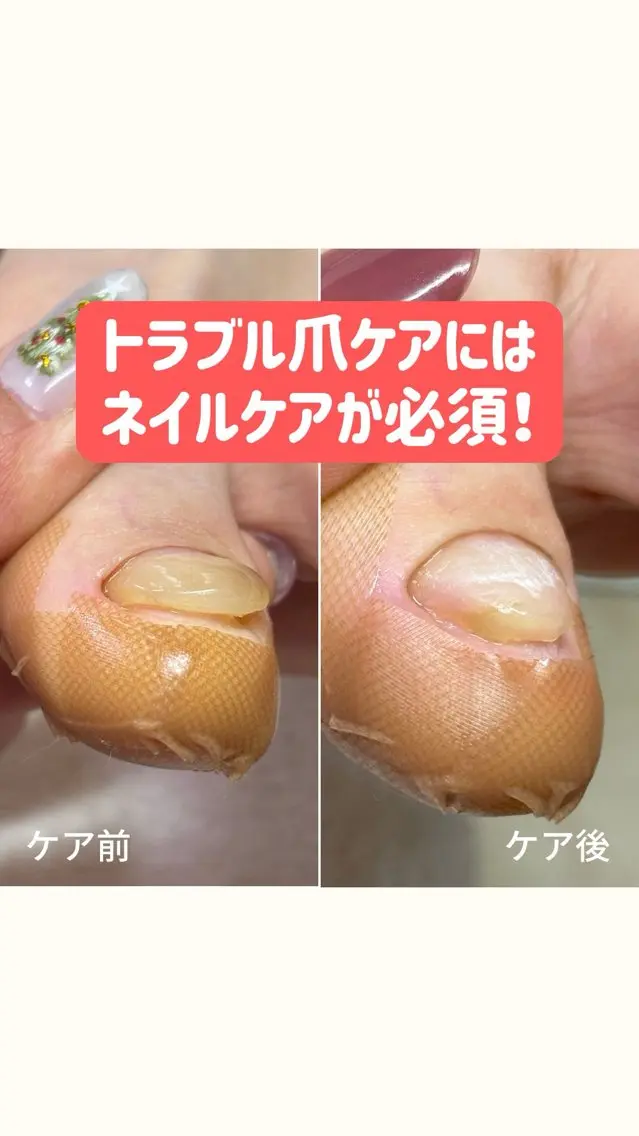 ネイル 巻き爪・肥厚爪ケア 専門サンセリテのネイルデザイン
