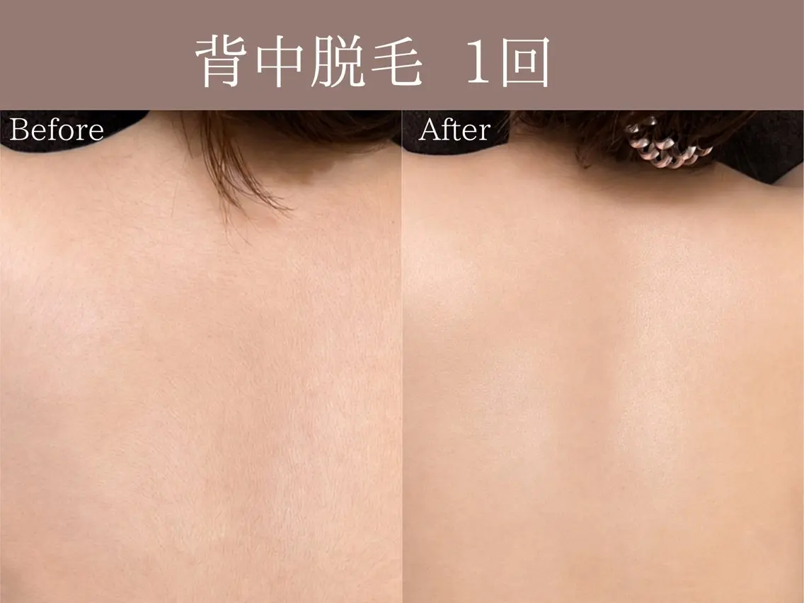美肌脱毛(大パーツ:背中)の写真