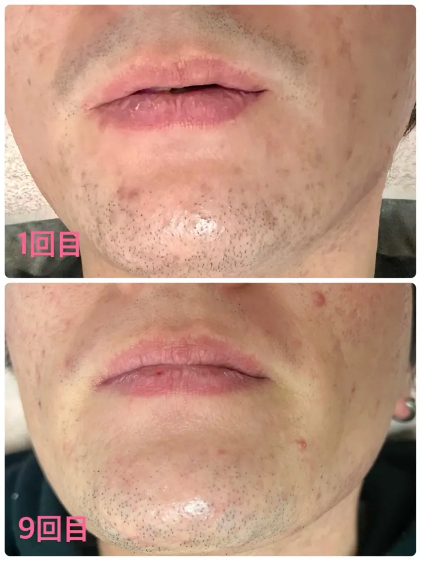 メンズ 脱毛 Mens Salon SOLEのエステ・リラクイメージ