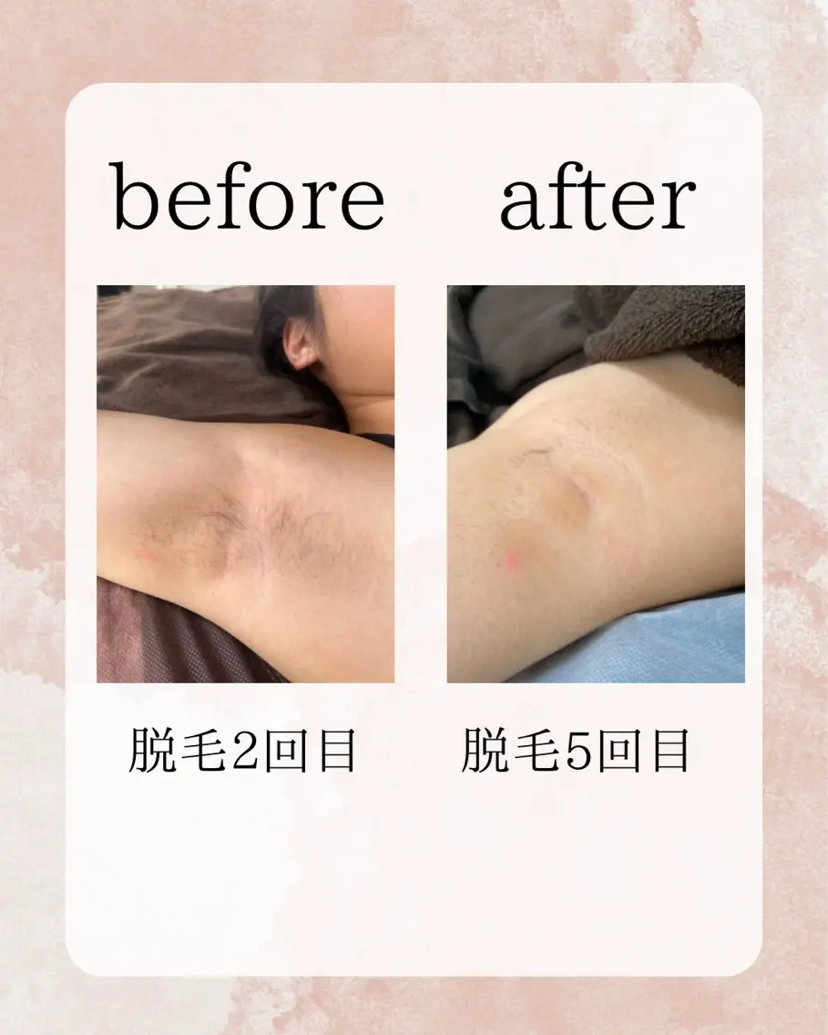 最新【スピード美肌脱毛】両脇1回の写真