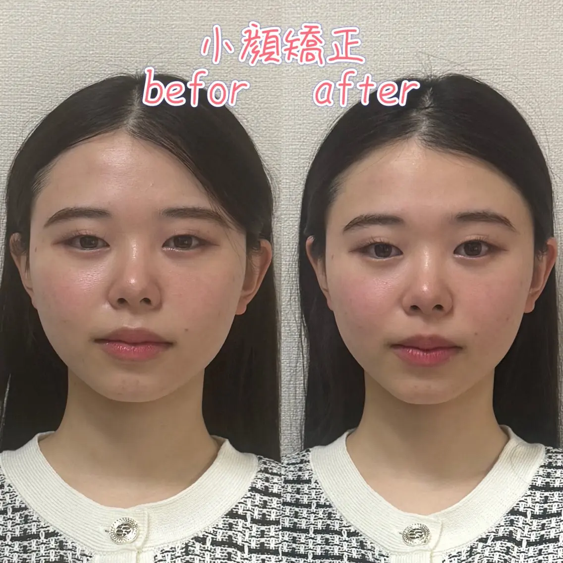 小顔矯正&カイロ骨格矯正全身110分の写真