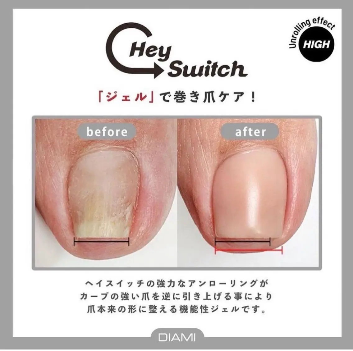 フット巻き爪・トラブル爪緩和の写真