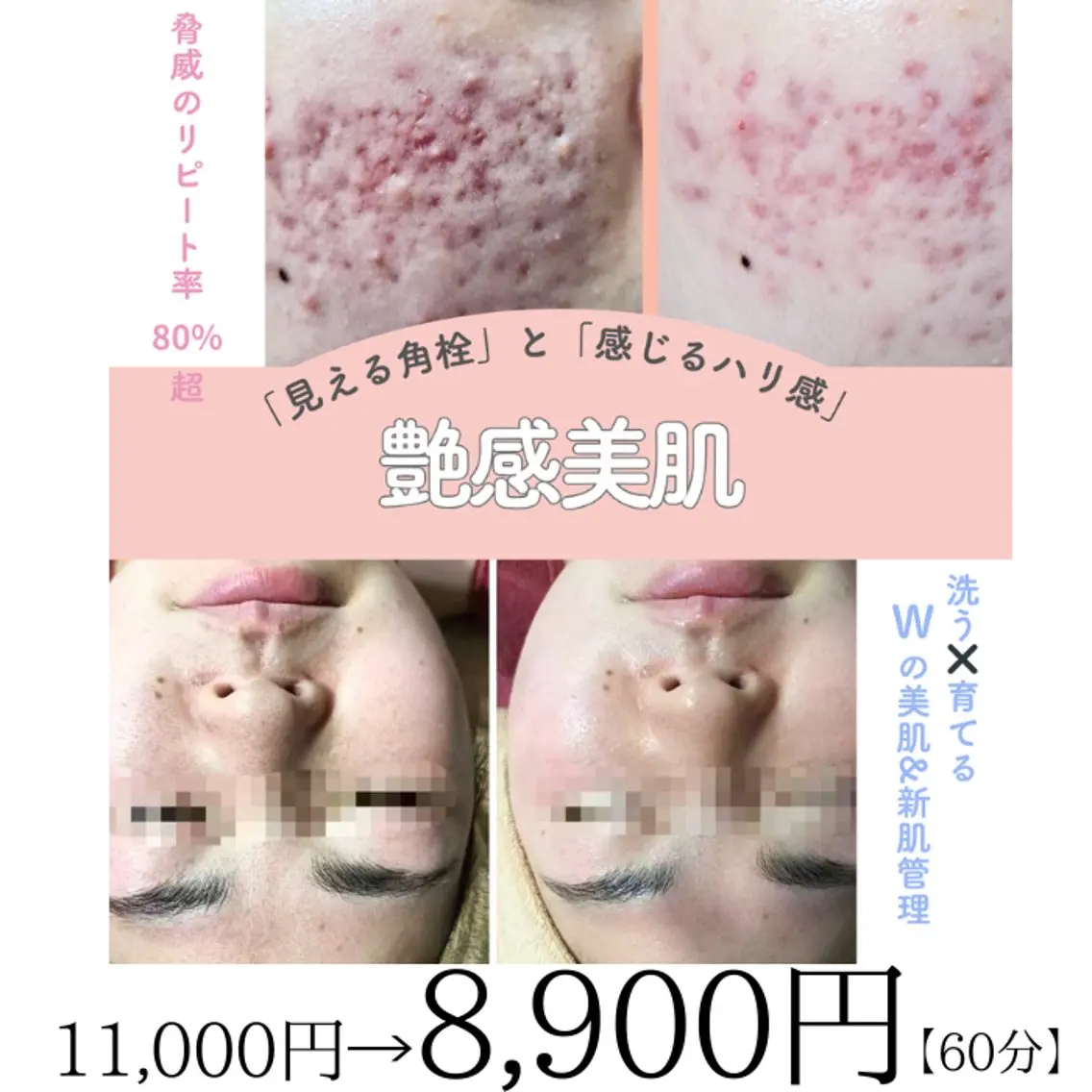 毛穴消滅×劇的小顔ケア|最新esV10を地域最安級で!【韓国式大掃除】の写真