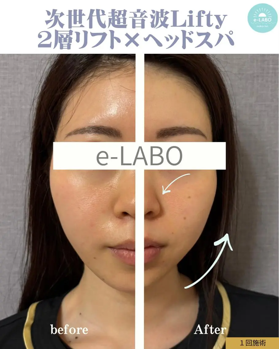 【脱・二重アゴ】Lifty２層リフト×ヘッドスパ◆横顔Vライン形成の写真