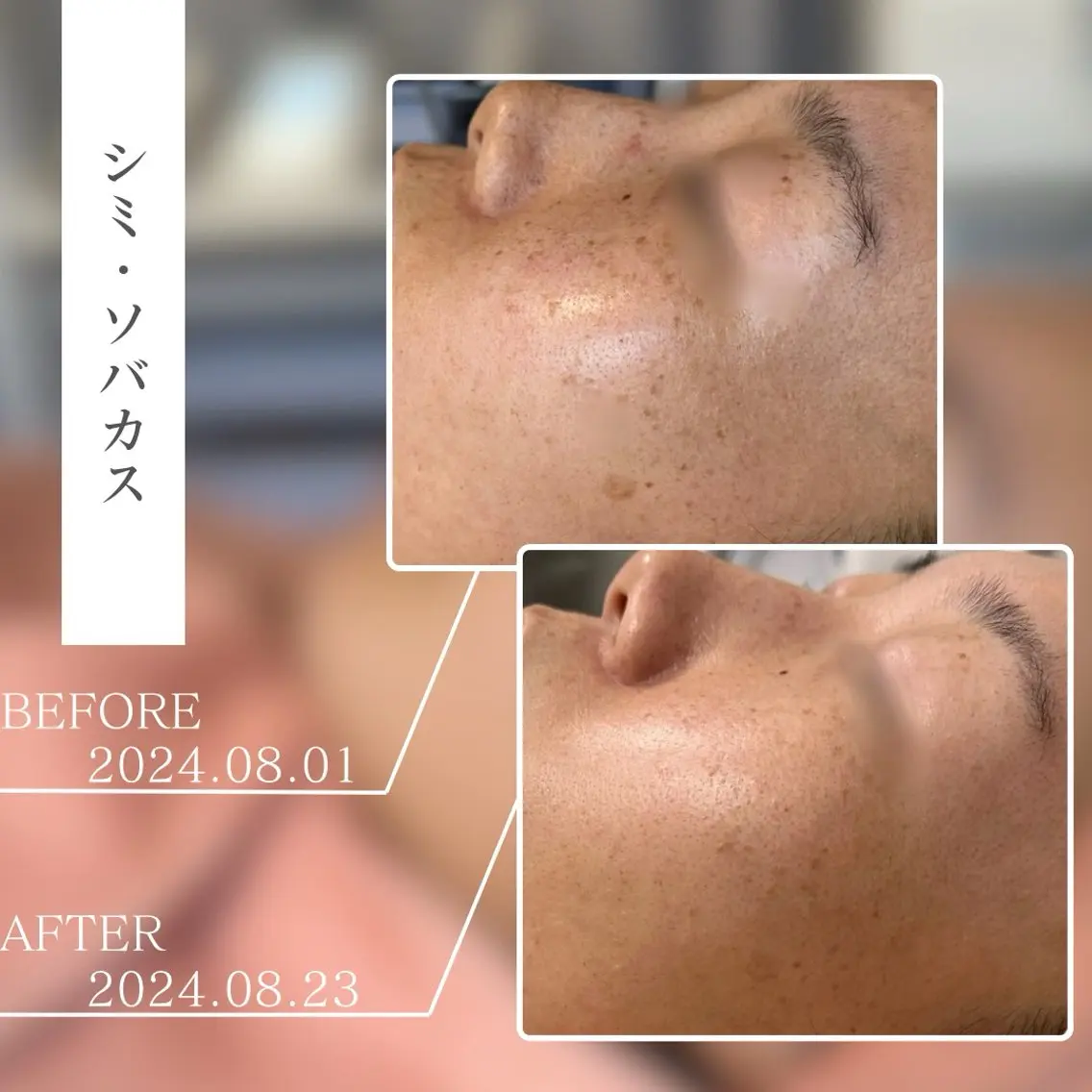 キッズ エステ BestBelleꕤ 大阪福島/肌質改善のエステ・リラクイメージ