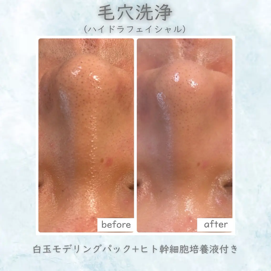 【全顔毛穴洗浄】ハイドラフェイシャル💧の写真