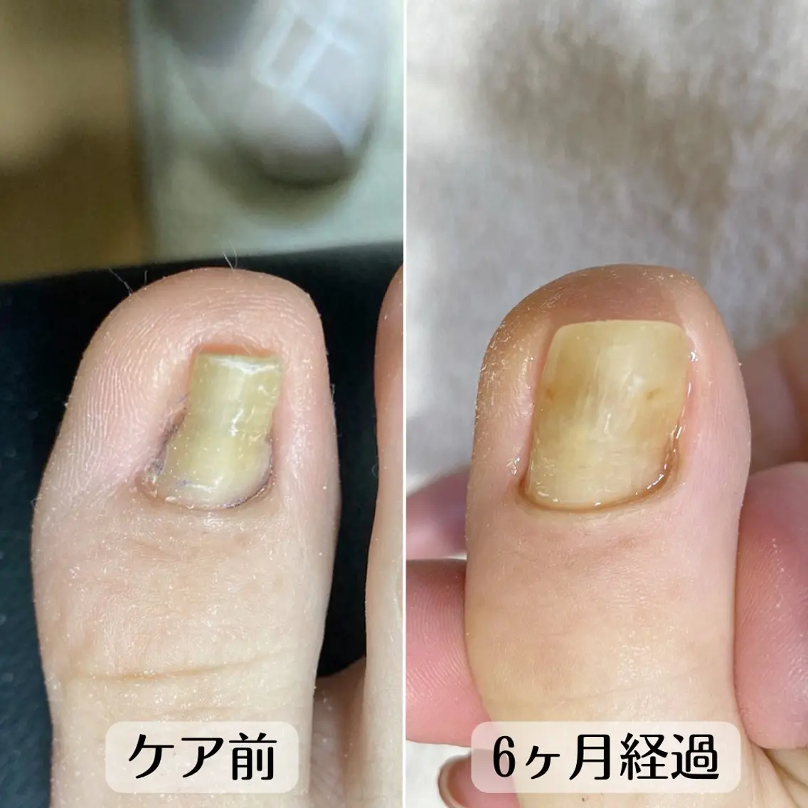 ネイル 深爪・巻き爪 専門サンセリテのネイルデザイン