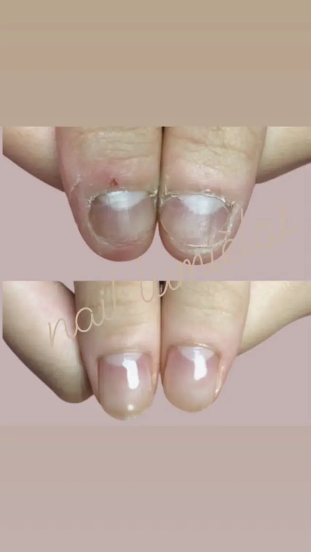 🍀毎週土曜日限定🍀深爪脱脚💅ネイルしながら深爪育成が出来る【初回体験・オフあり】無料で好きなカラーが選べるの写真
