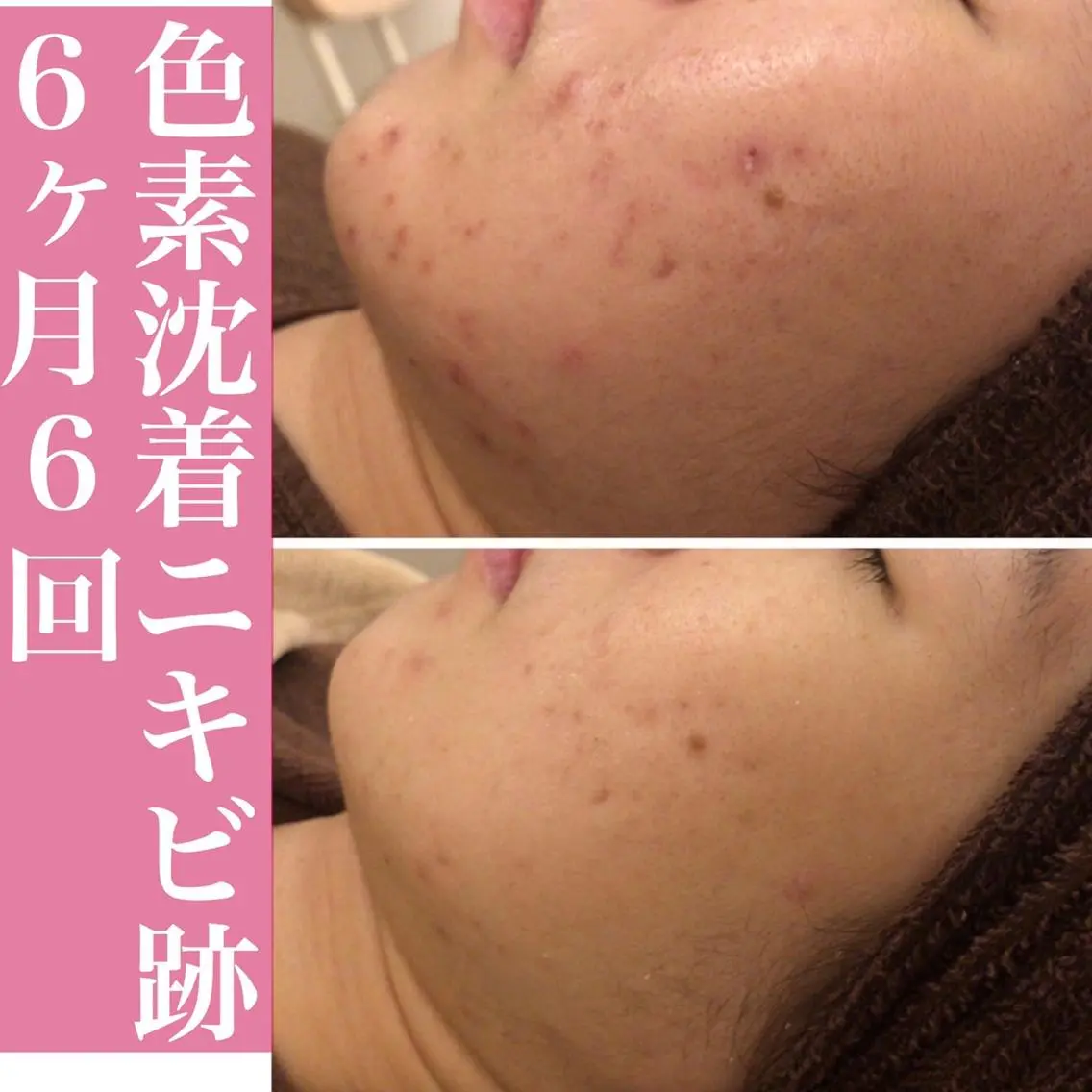 ミディアム パーマ ネイル マツエク・マツパ アイブロウ ニキビ・肌質改善専門 ♡人生が変わるサロンのエステ・リラクイメージ