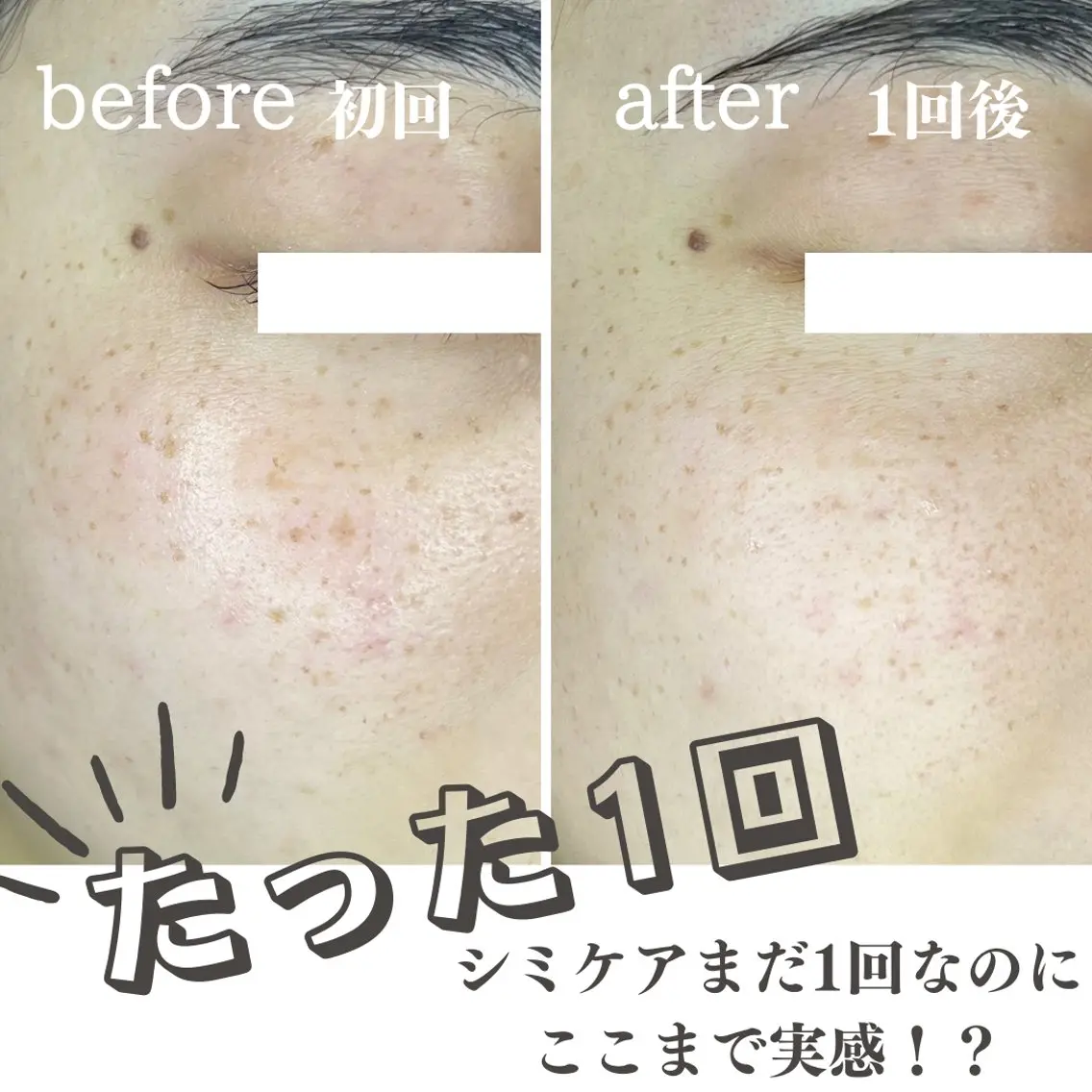 シミケア20ショット＋超音波毛穴洗浄コースの写真