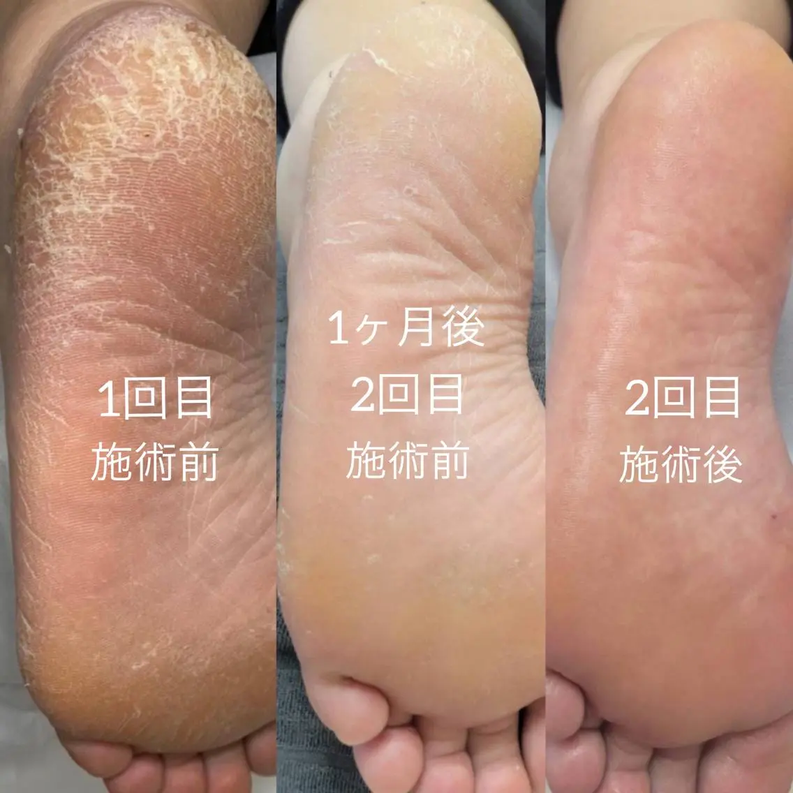 常識をくつがえす新しい角質ケア！！『エンザイム角質ビットケア®︎』の写真