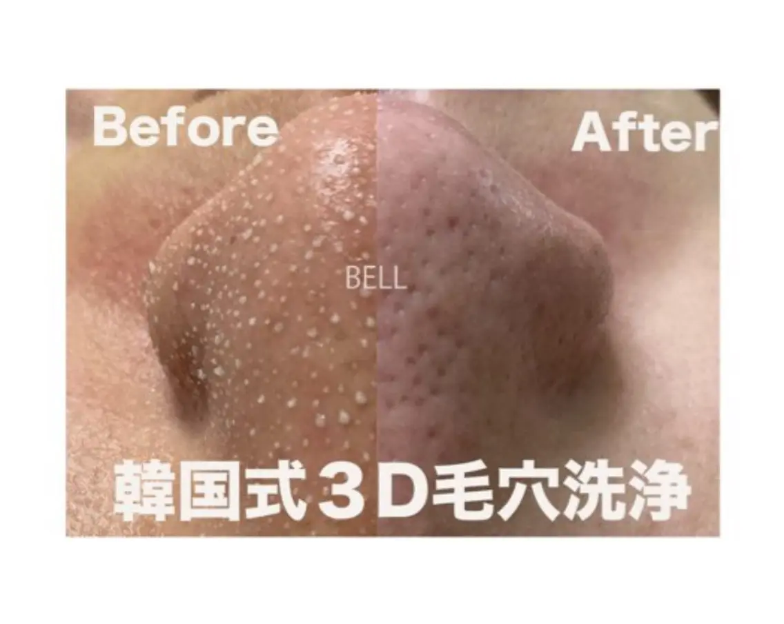 練習モデル募集🍀韓国式3D毛穴洗浄🇰🇷強い皮脂感や黒ずみ、頑固な毛穴汚れを撃退！メンズ◎人気No.1の全顔施術✨️の写真
