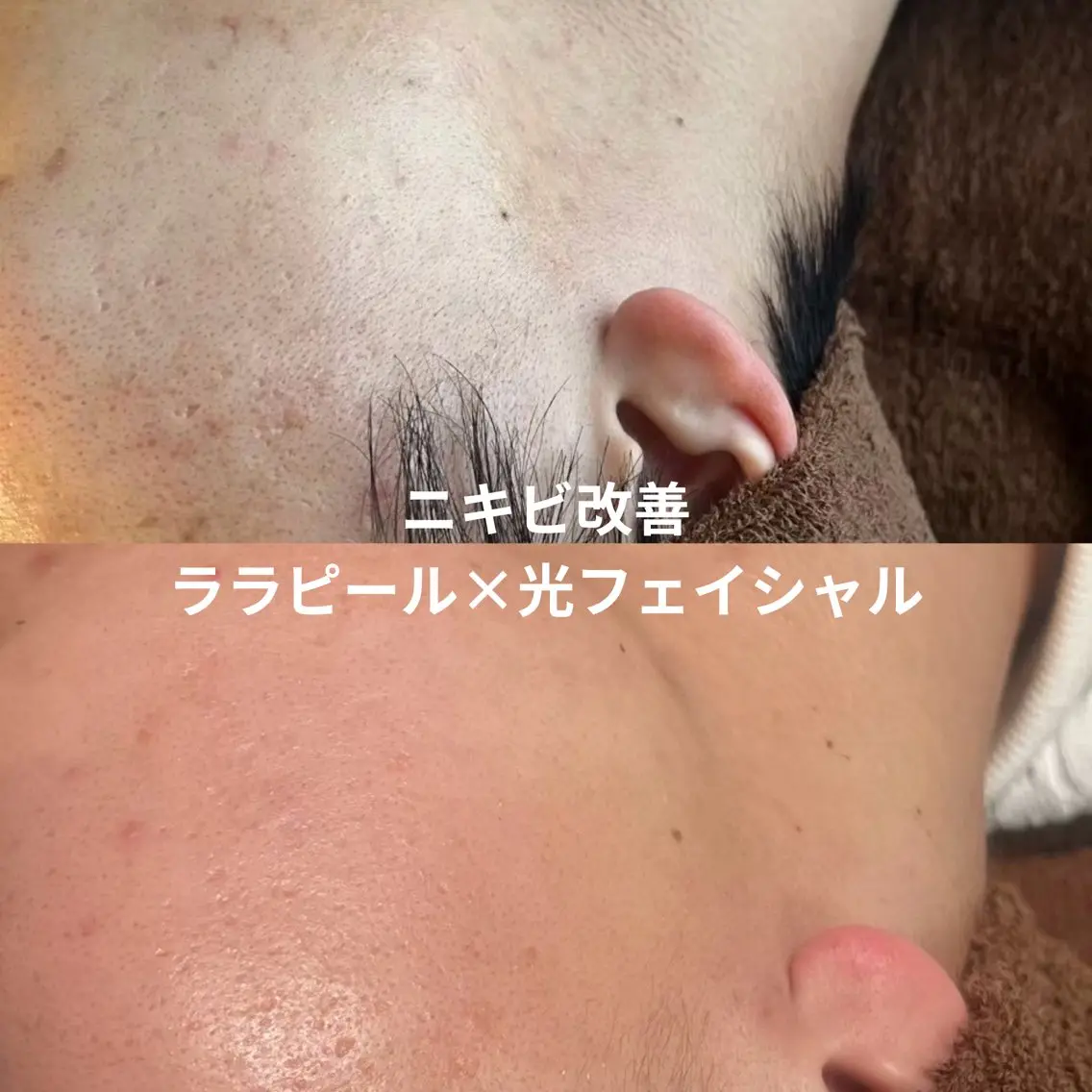 ララピール × 光フェイシャル|透明感&つるん肌セットの写真