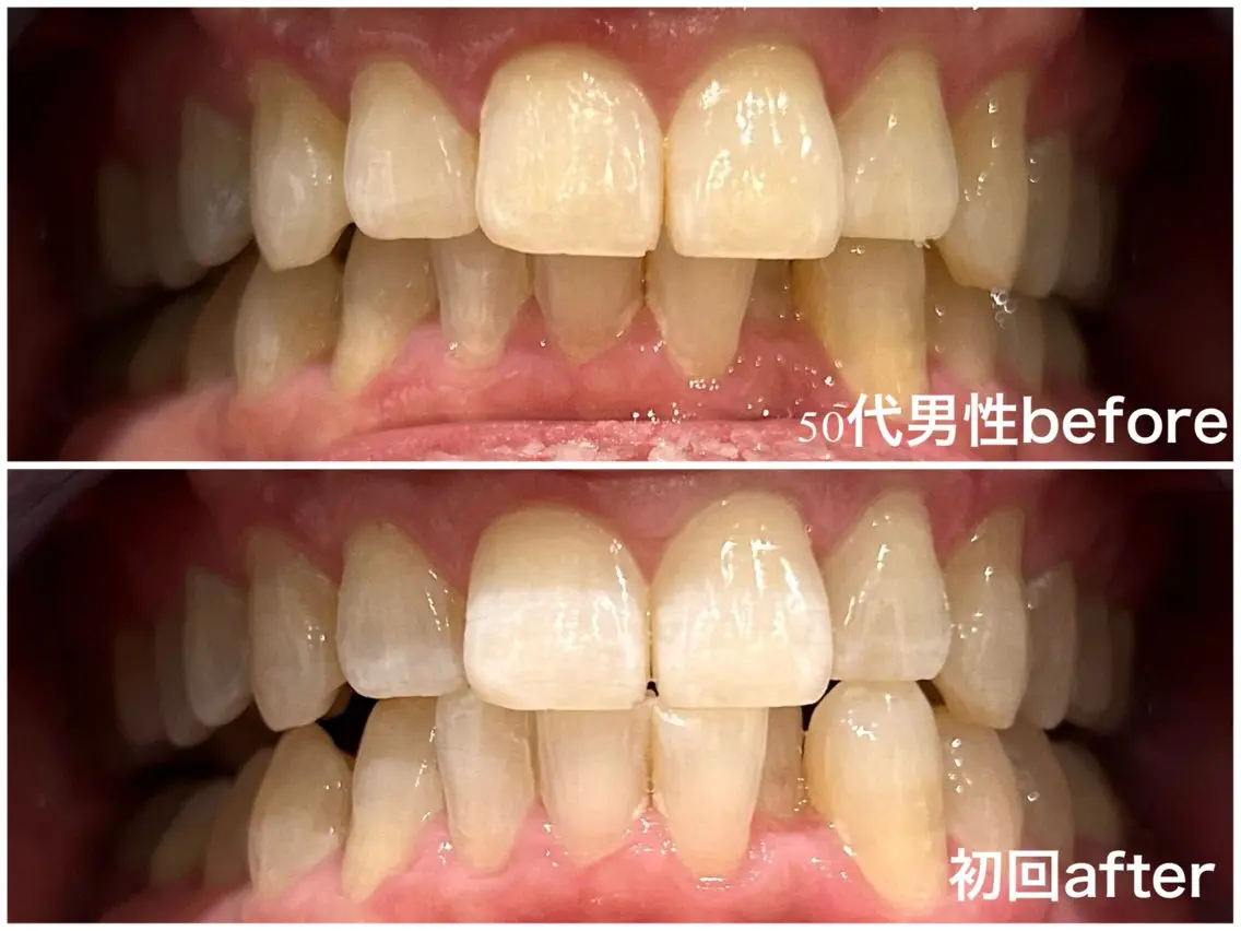 セルフホワイトニング30分の写真