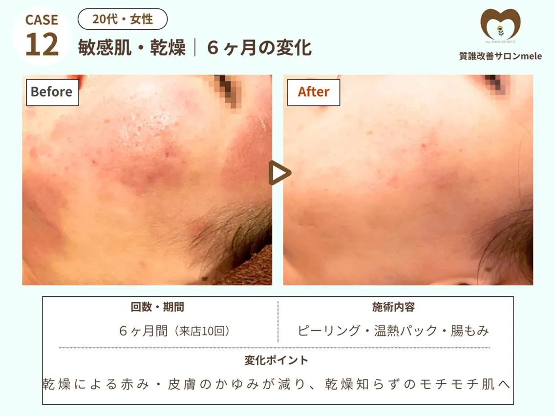 エステ リラク ニキビケア・毛穴専門 mele|もりぞののエステ・リラクイメージ