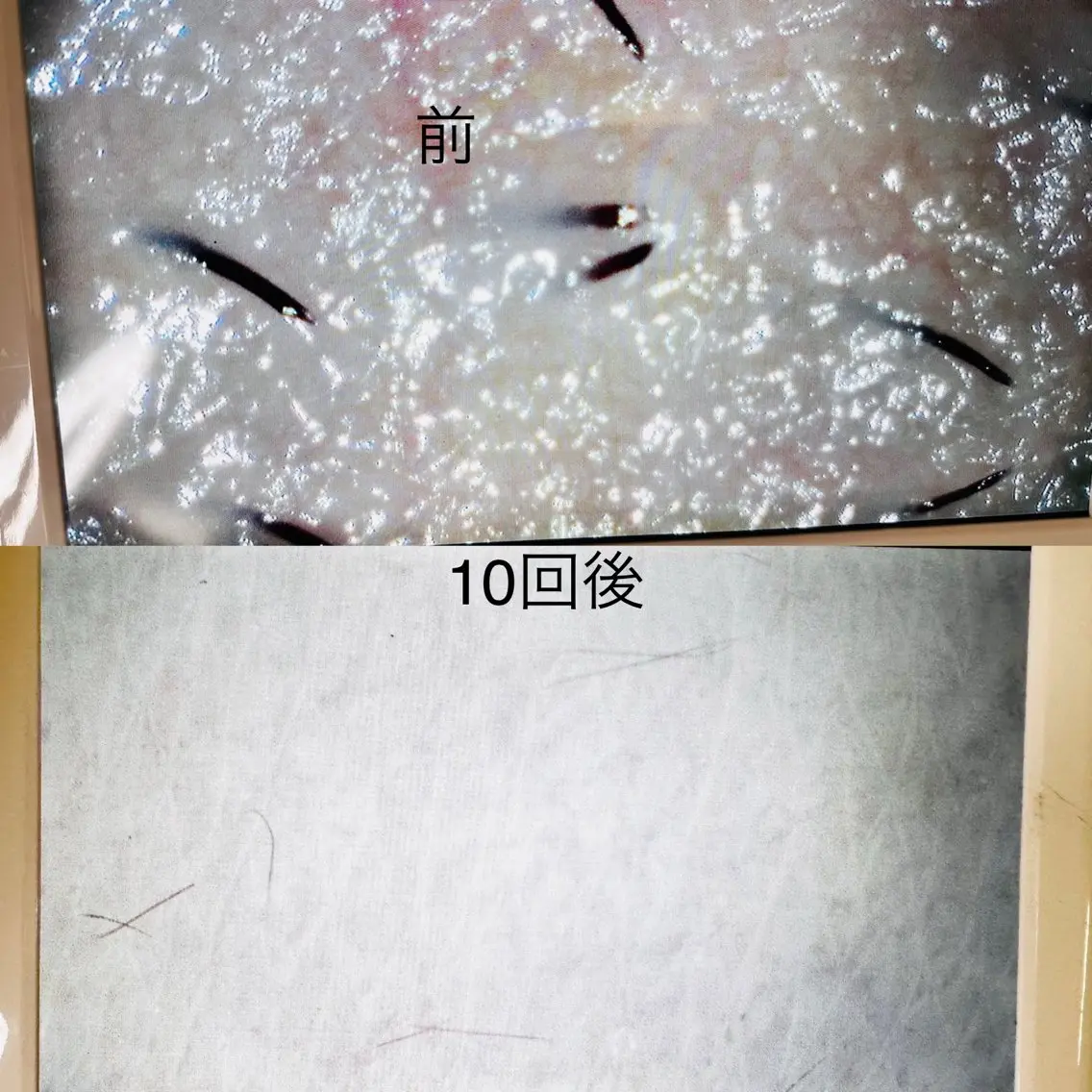 Vio 脱毛の写真