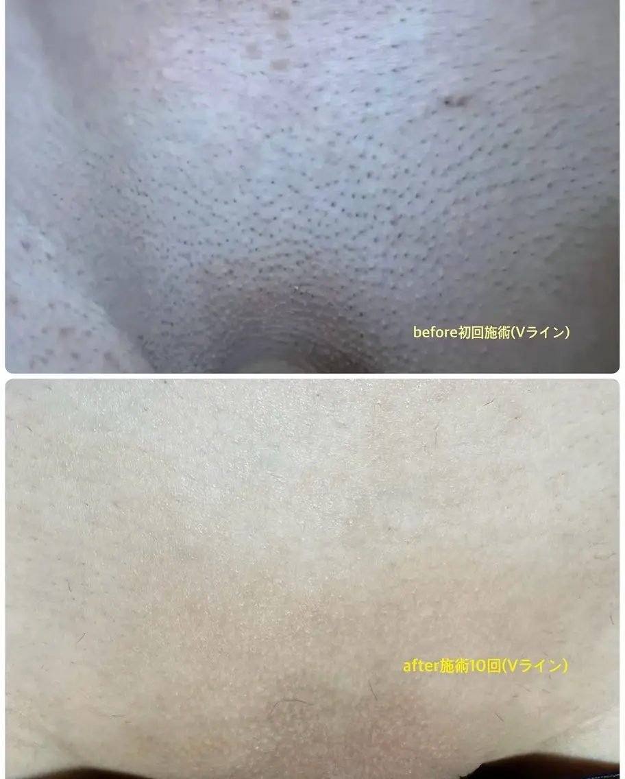 VIO脱毛の写真