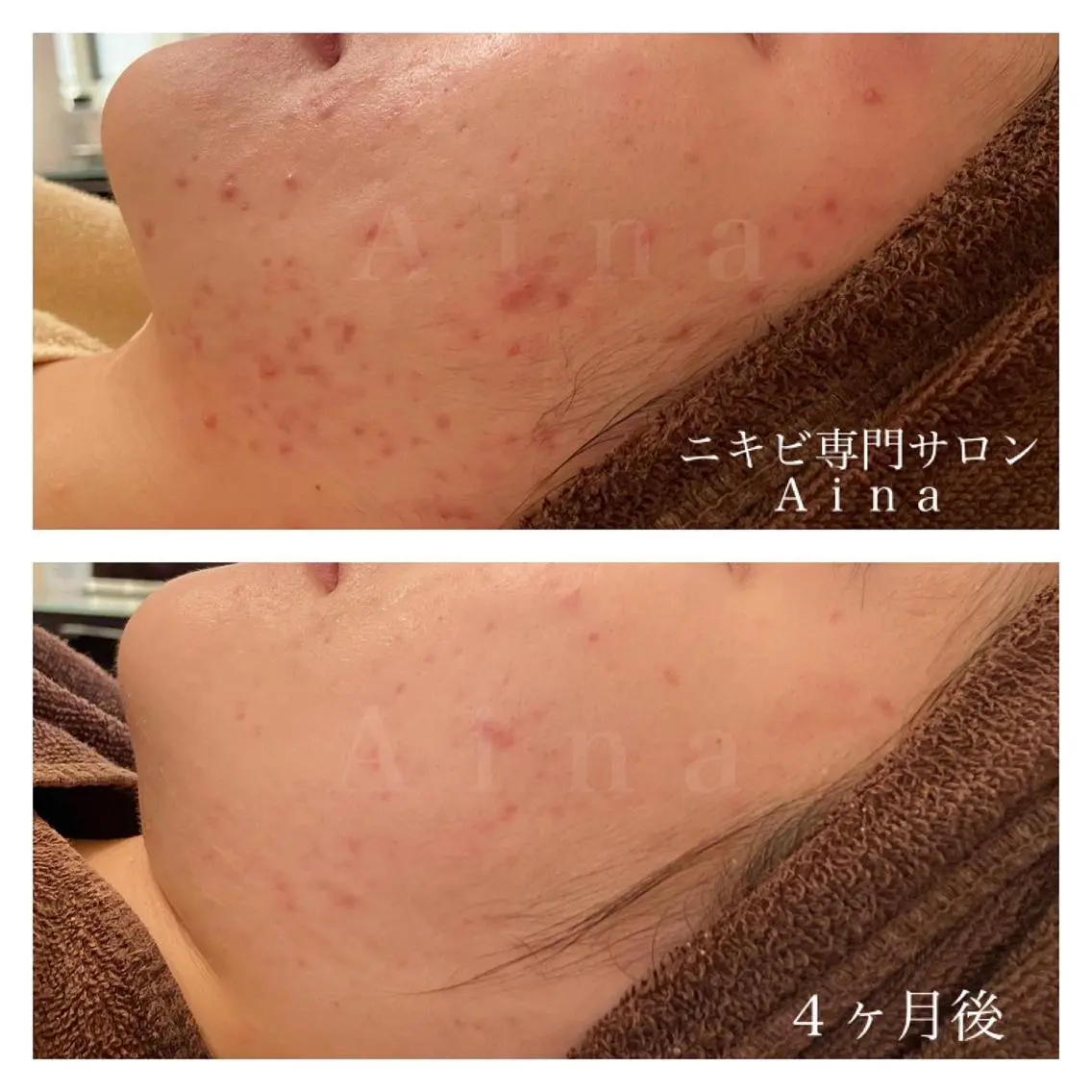 ミディアム カラー パーマ ヘアアレンジ メンズ キッズ ネイル マツエク・マツパ ニキビ跡専門サロン Ａｉｎａのエステ・リラクイメージ