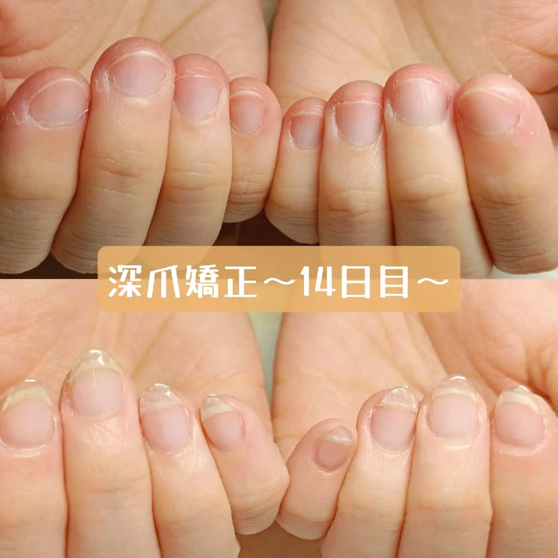ネイル ジェルネイル ハンドネイル ハンドケア 深爪矯正/爪育成ケア manie nailのネイルデザイン
