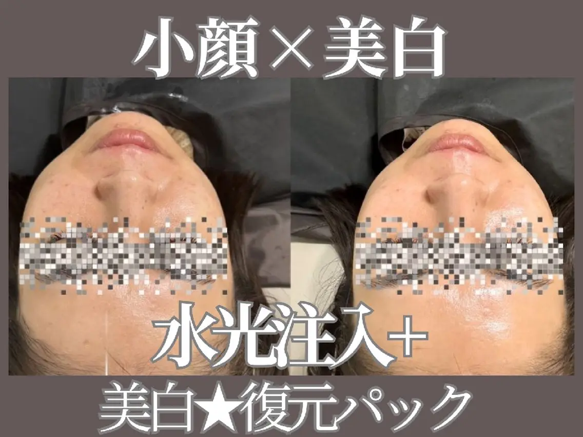 小顔×美白　針なし水光＋高濃度酸素導入＋ジェルパック ¥17600→¥7700の写真