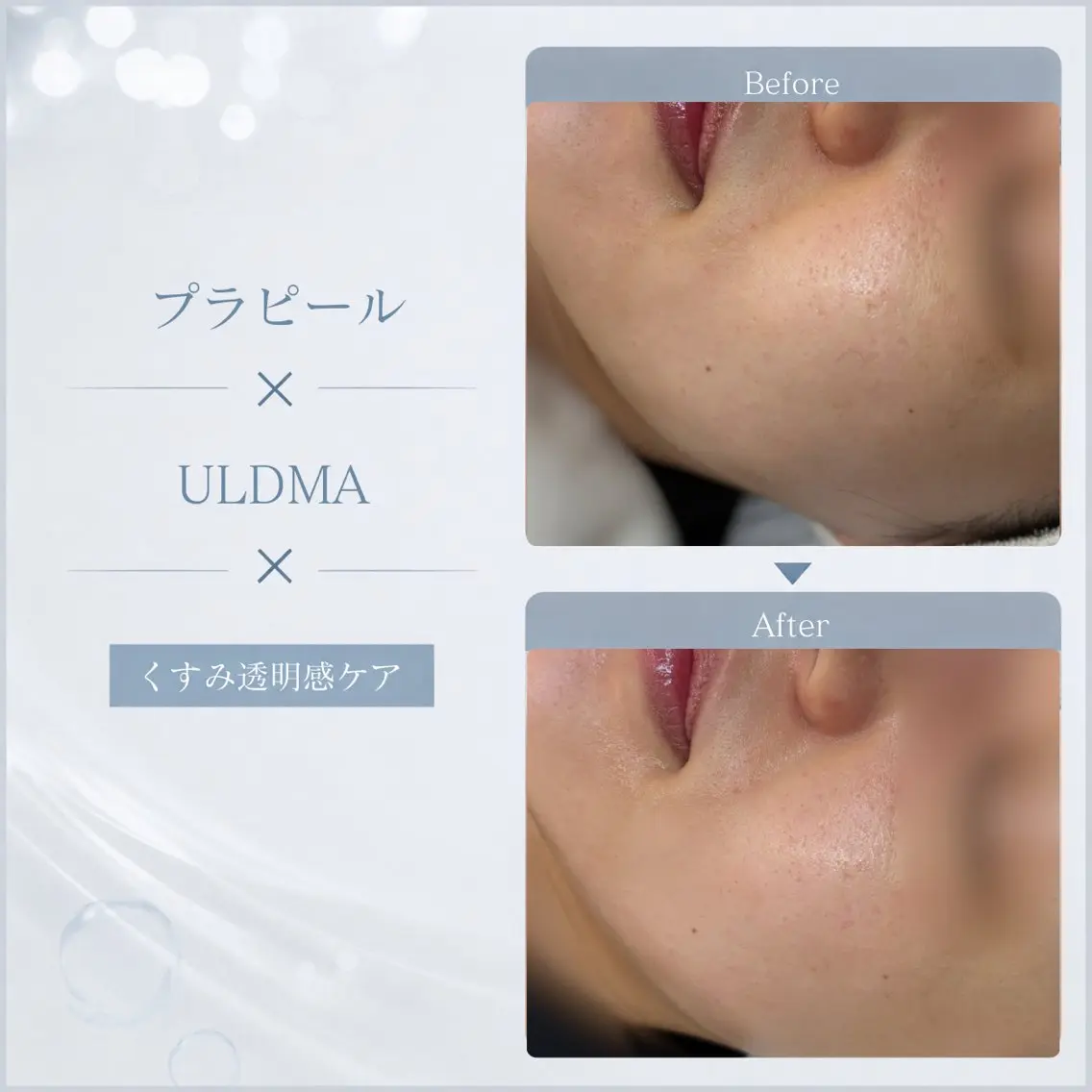 《透明感水光肌✨》プラピール＋ULDMA＋プラズマニードル 【 保湿/くすみ/美白/シミ/肝斑ケア 】の写真