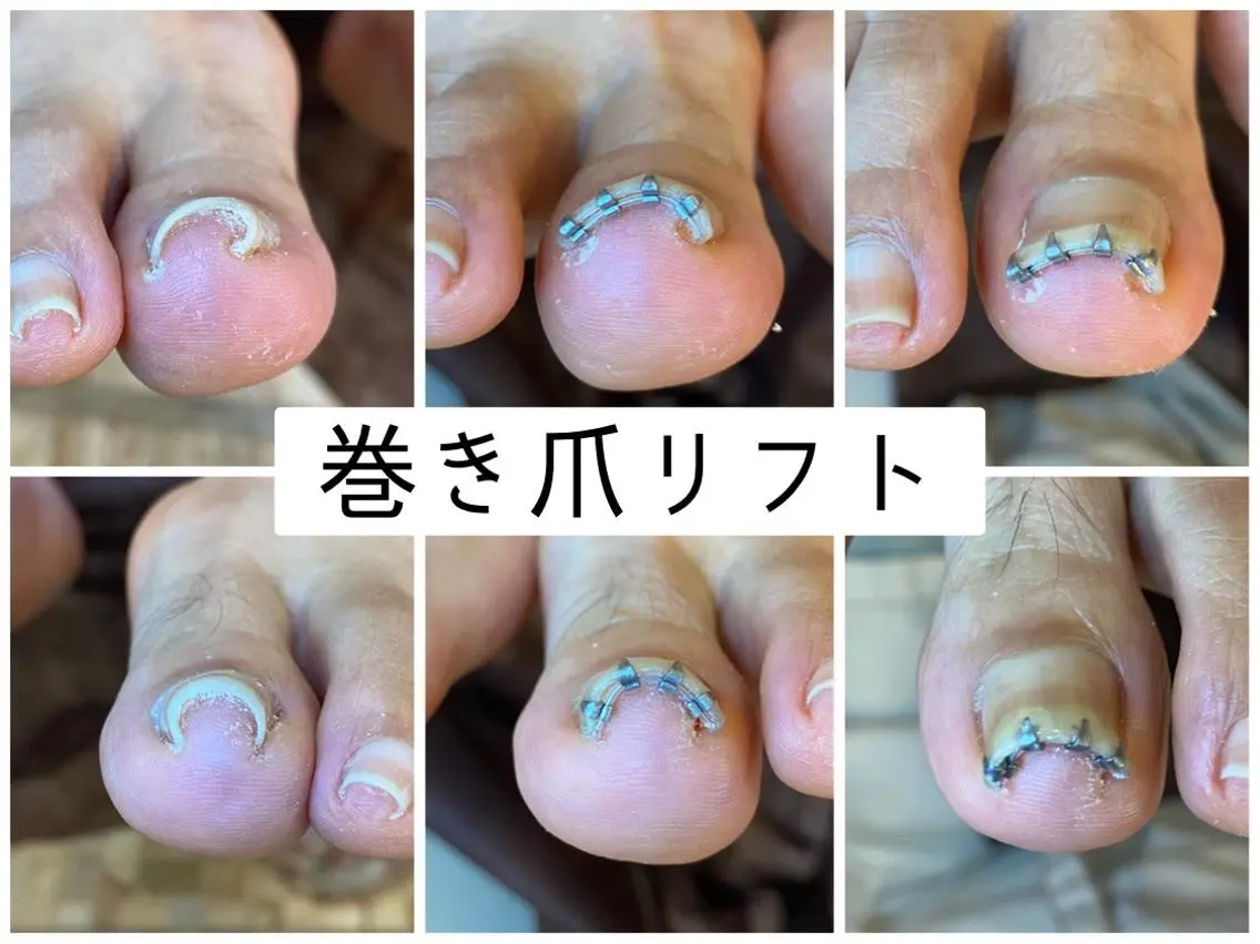 ネイル ♢ME2ROOM♢ #巻き爪#リラクのネイルデザイン