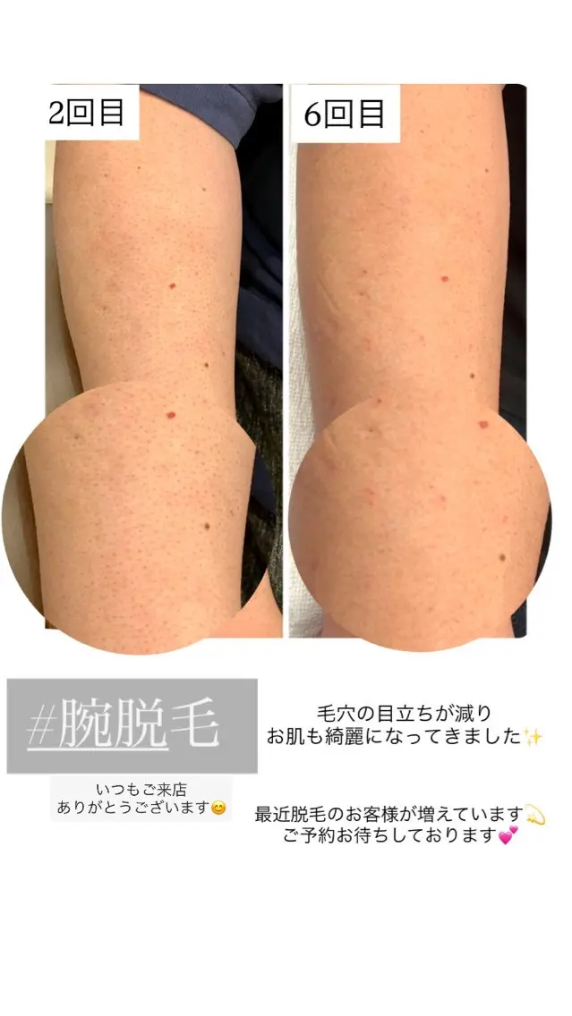 腕脱毛（指先、脇込）¥7000→¥6000の写真