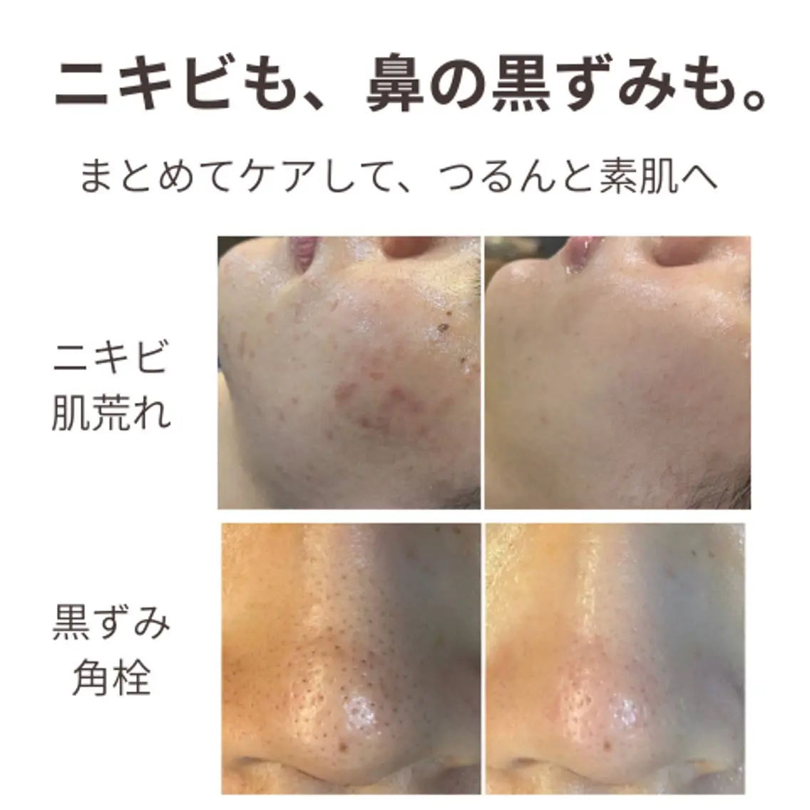 【ニキビ・鼻の黒ずみに】鼻の毛穴吸引+ハーブピーリング🌿剥離なし、ダウンタイムなし、敏感肌◎の写真