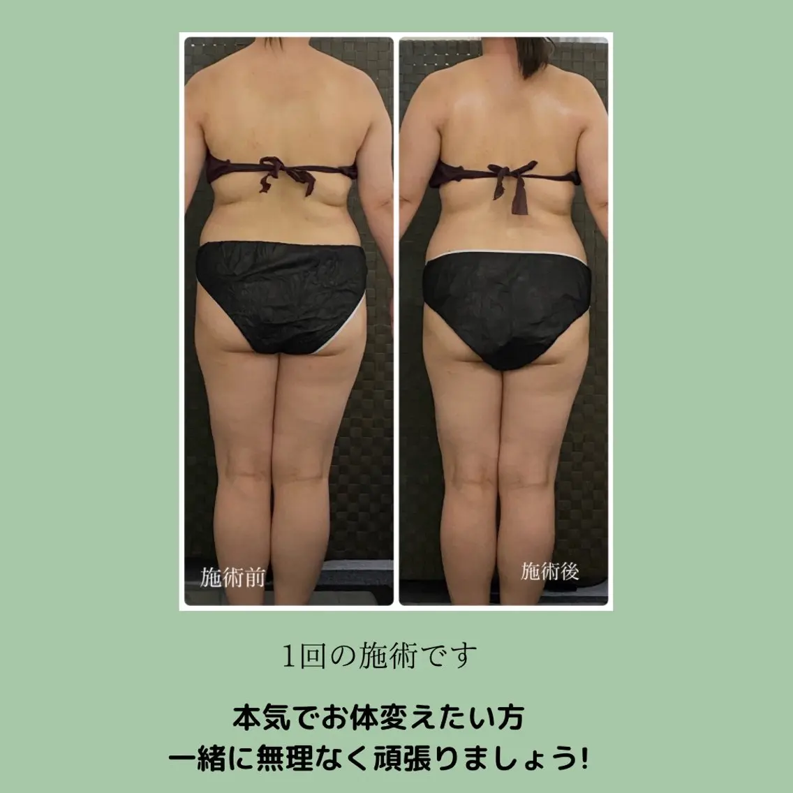 筋膜リリース(90分)の写真