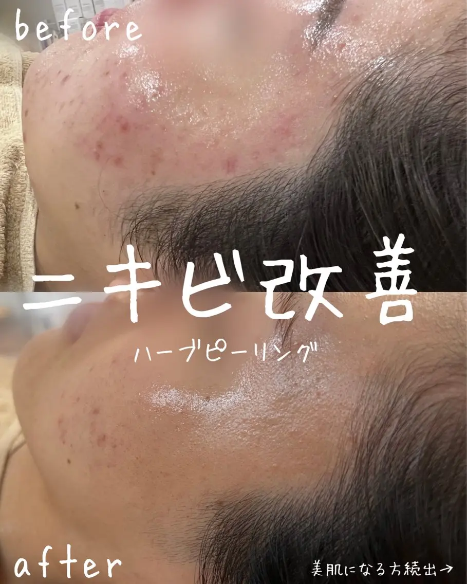 【人気ＮＯ.1】ニキビ・赤み肌改善♡陶肌ハーブトリートメント＋艶肌ミストの写真