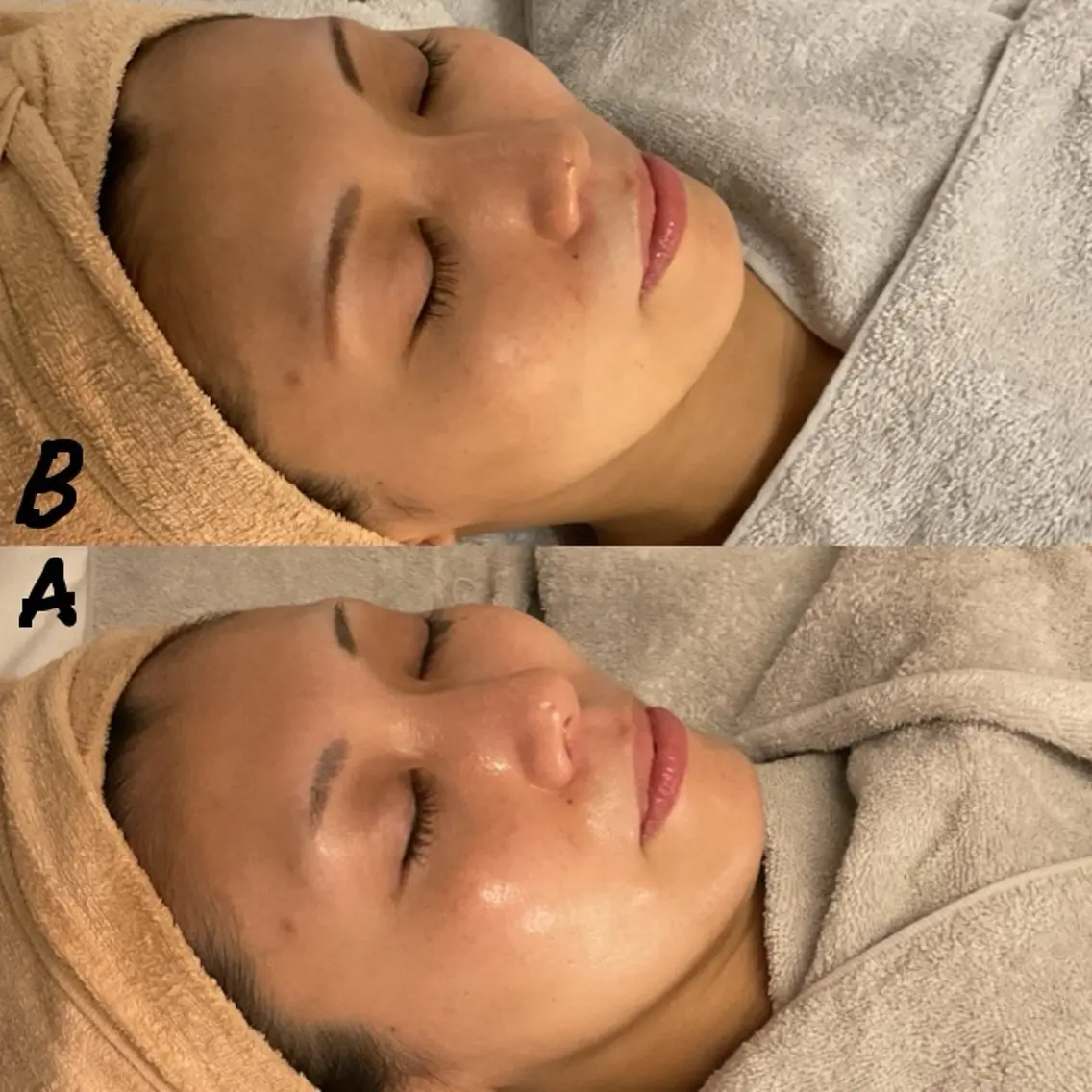 ✨すっきり艶肌💆🏼‍♀️たるみ解消フェイシャル モニター✨の写真