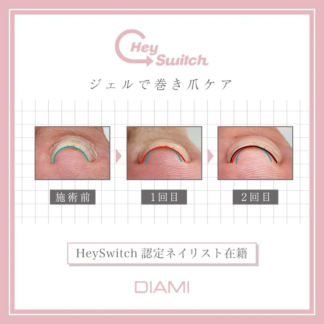 巻き爪でお悩み方募集ジェルを使って巻き爪ケアをします。痛くない爪を手に入れませんか?の写真